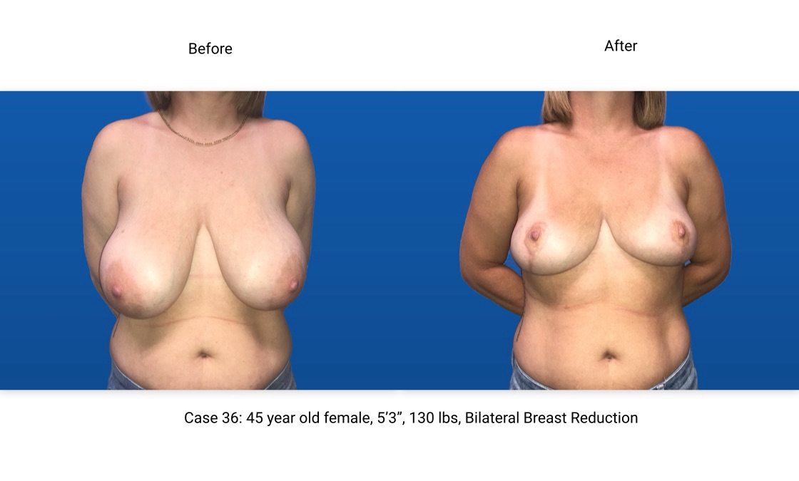 Case 36 Breast Reduction Front View