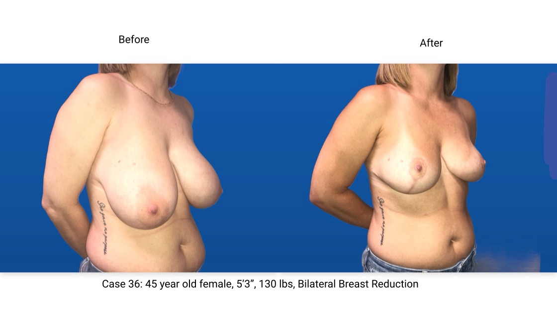 Case 36 Breast Reduction 3/4 View