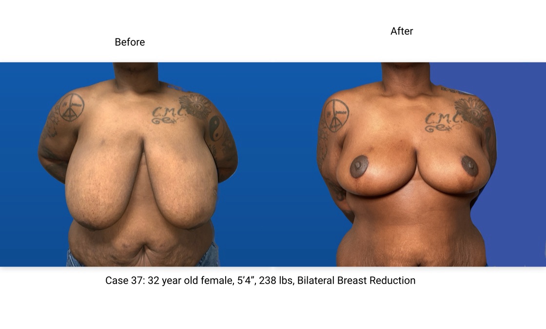 Case 37 Breast Reduction Front View