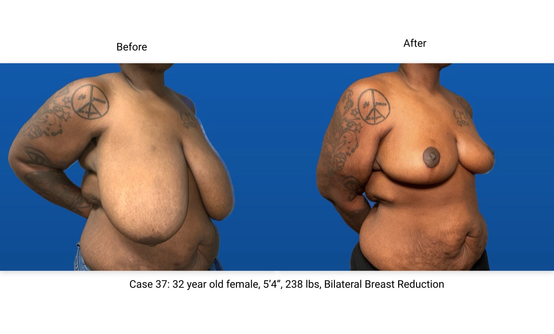 Case 37 Breast Reduction 3/4 View