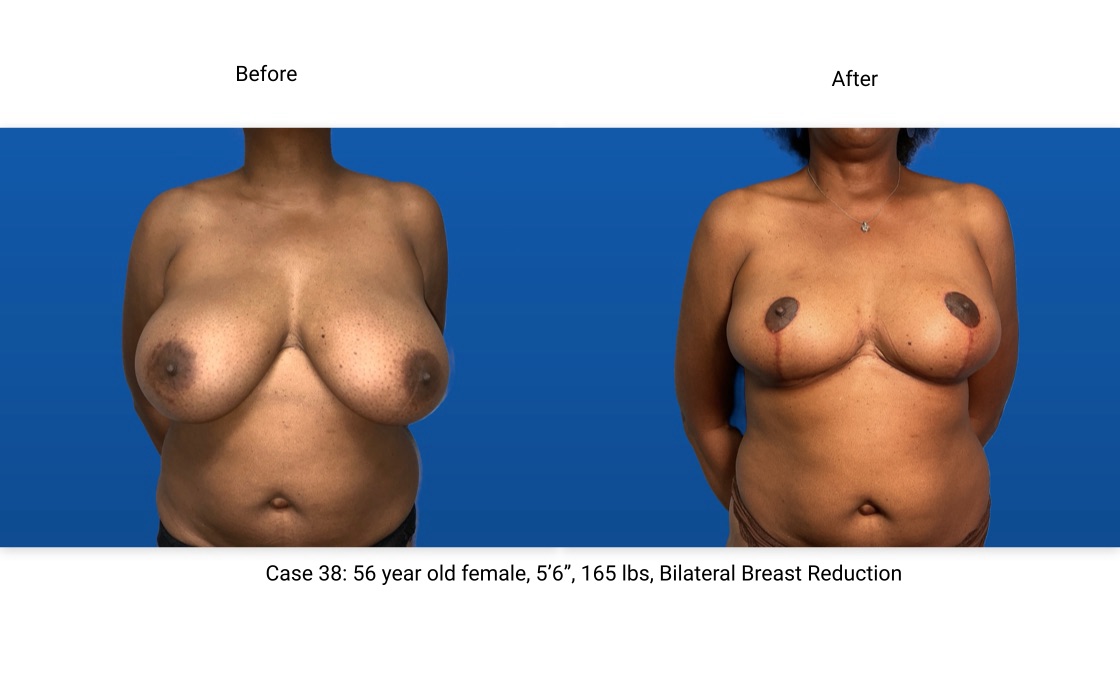 Case 38 Breast Reduction Front View