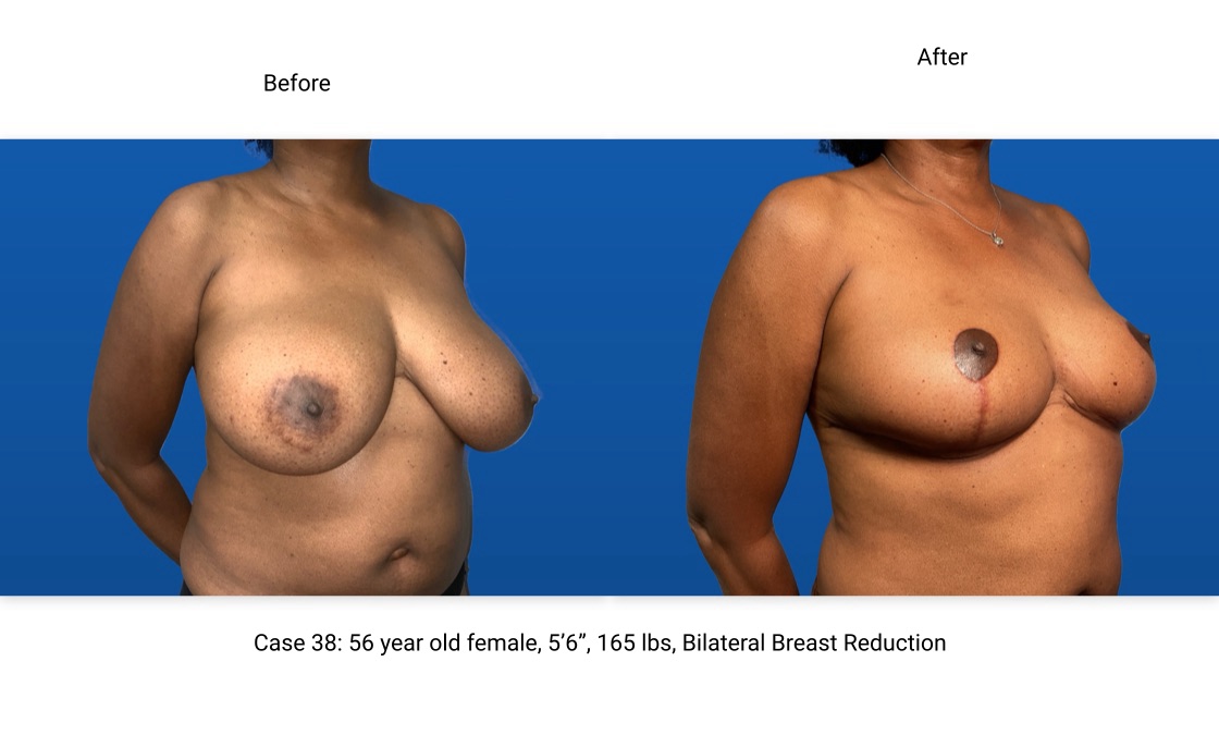 Case 38 Breast Reduction 3/4 View