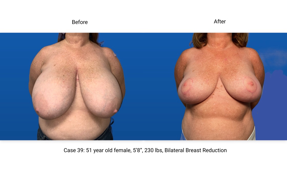 Case 39 Breast Reduction Front View