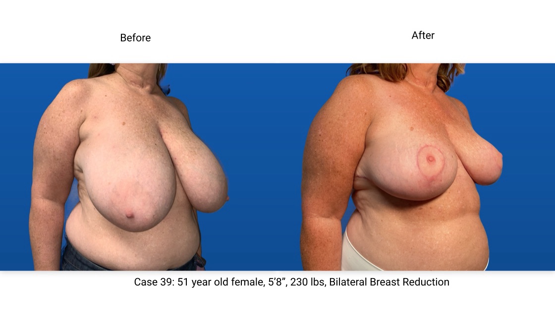 Case 39 Breast Reduction 3/4 View