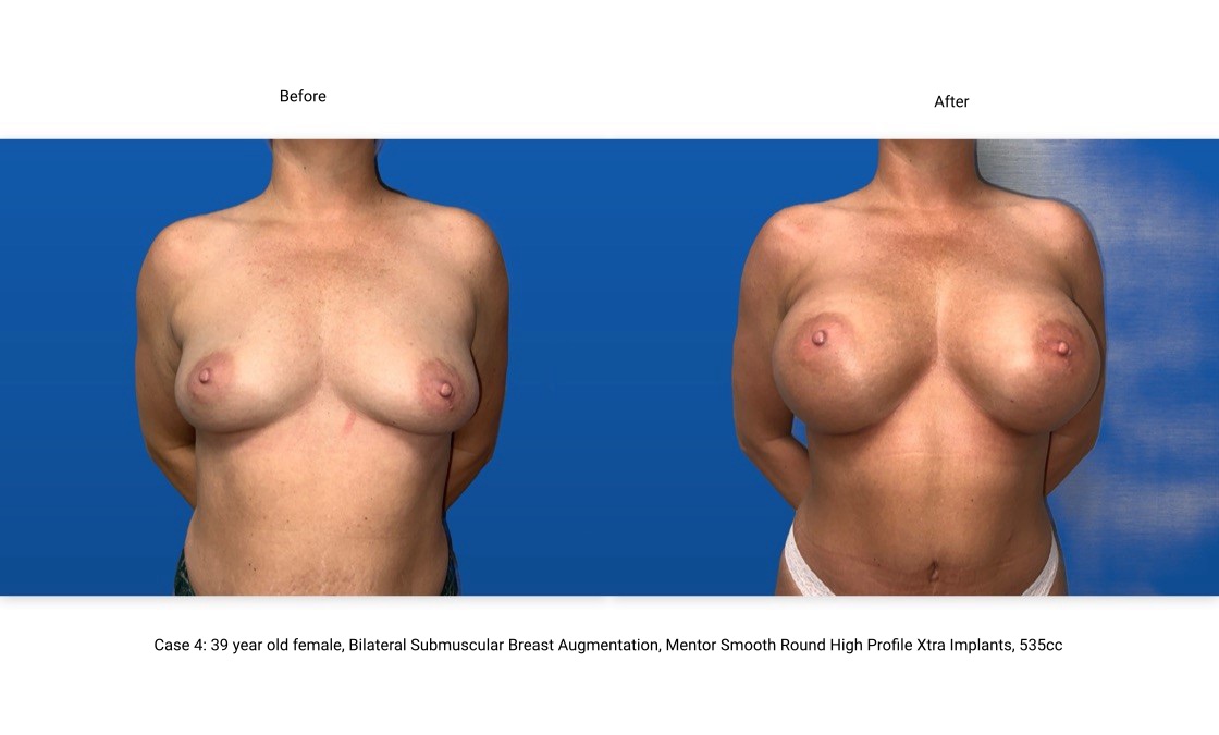 Case 4 Breast Augmentation Front View