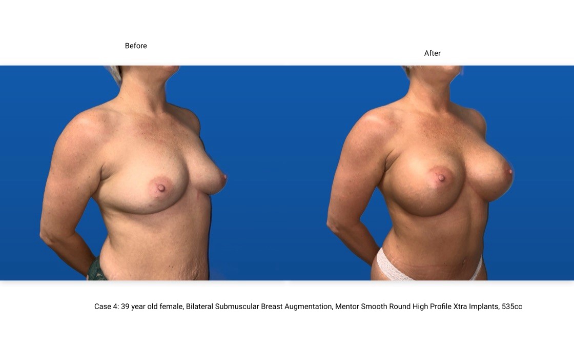 Case 4 Breast Augmentation 3/4 View