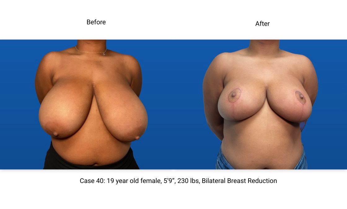 Case 40 Breast Reduction Front View
