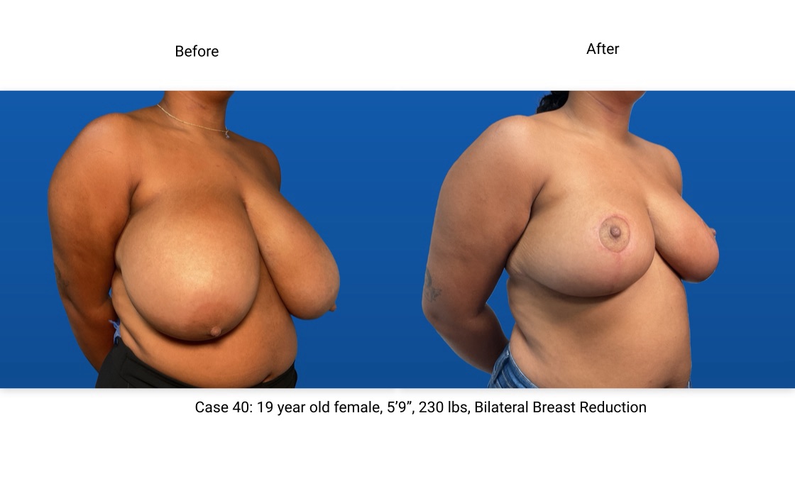 Case 40 Breast Reduction 3/4 View