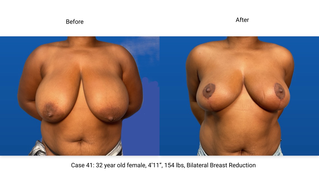 Case 41 Breast Reduction Front View