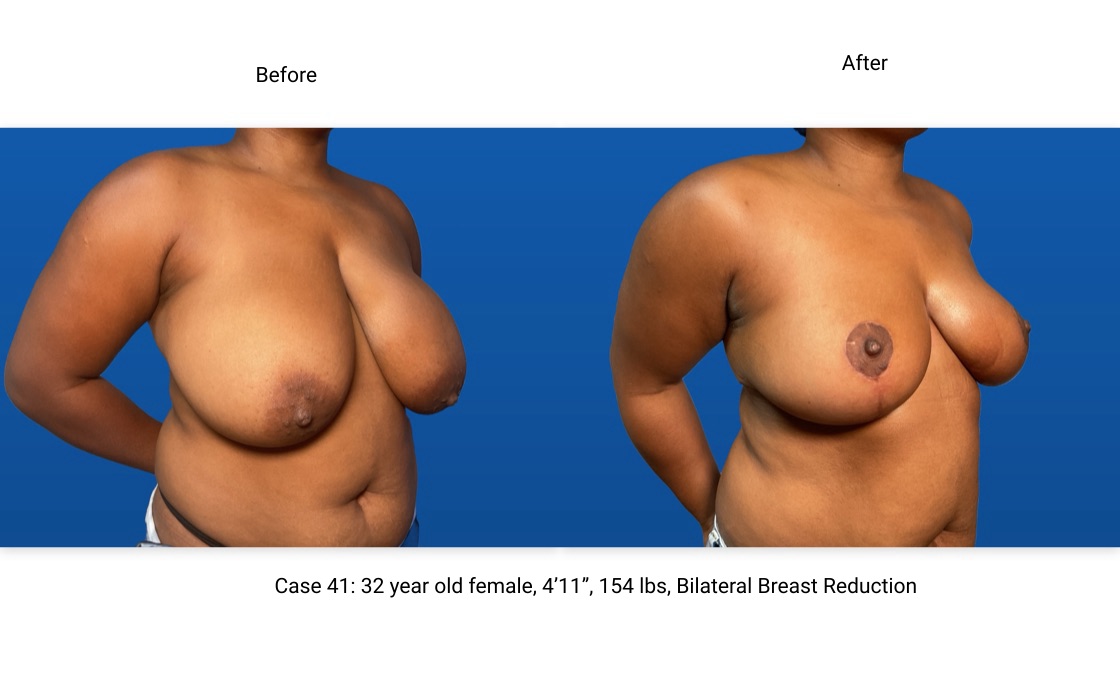 Case 41 Breast Reduction 3/4 View