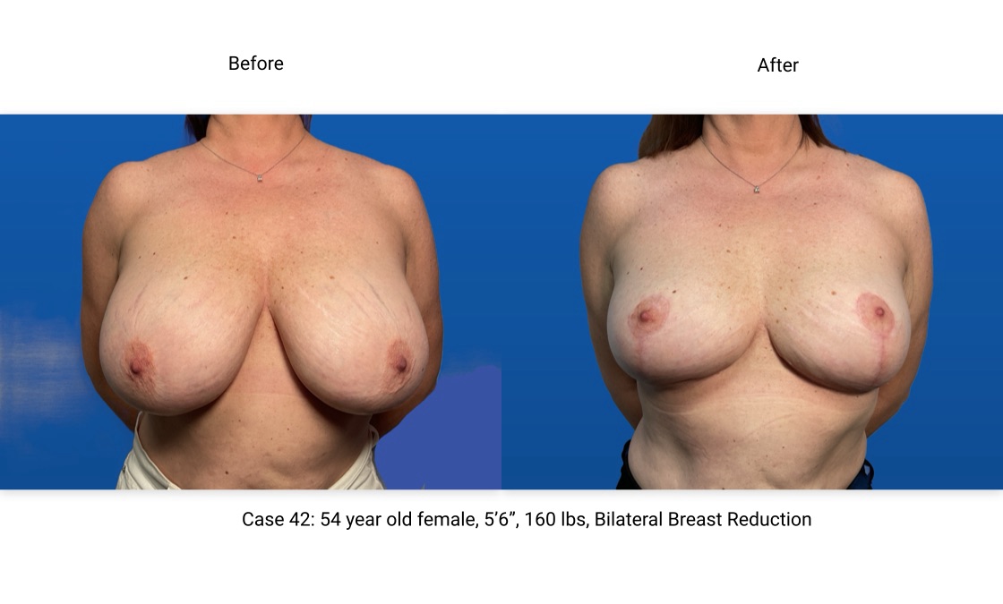 Case 42 Breast Reduction Front View