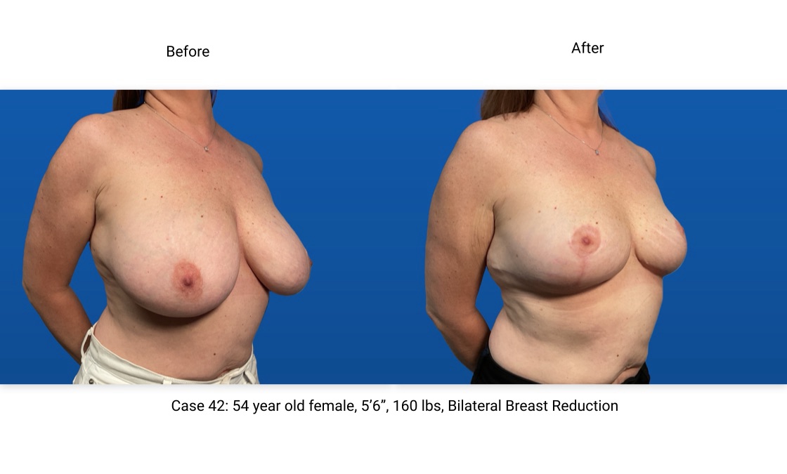 Case 42 Breast Reduction 3/4 View