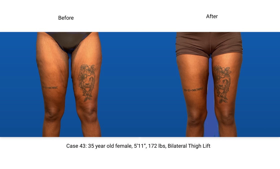 Case 43 Thigh Lift Front View