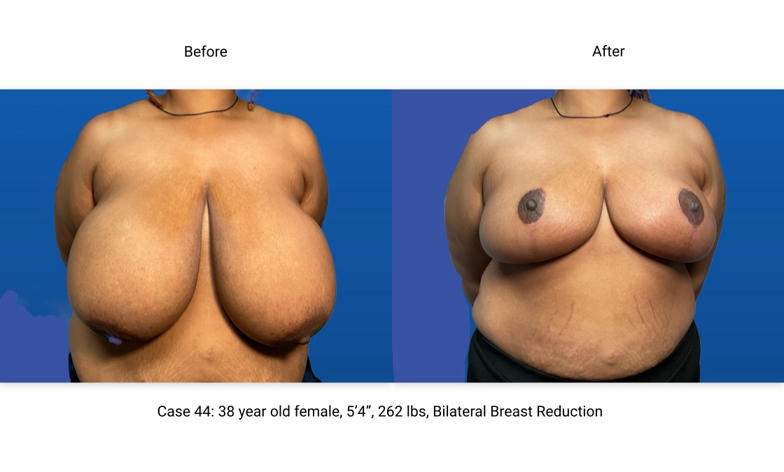 Case 44 Breast Reduction Front View