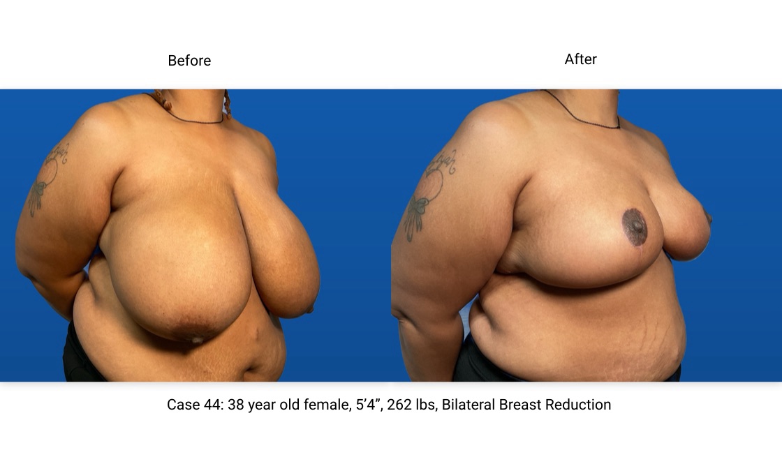 Case 44 Breast Reduction 3/4 View