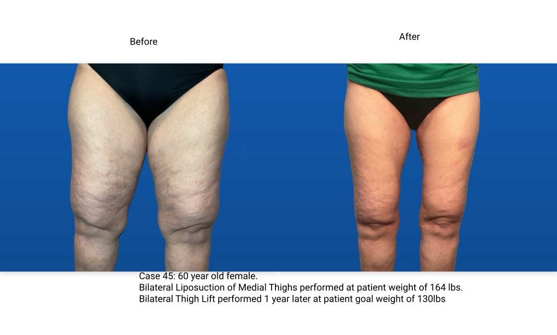 Case 45 Thigh Lift Front View
