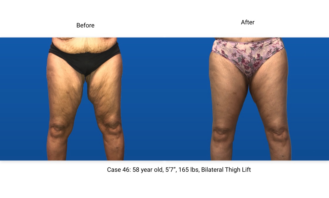 Case 46 Thigh Lift Front View