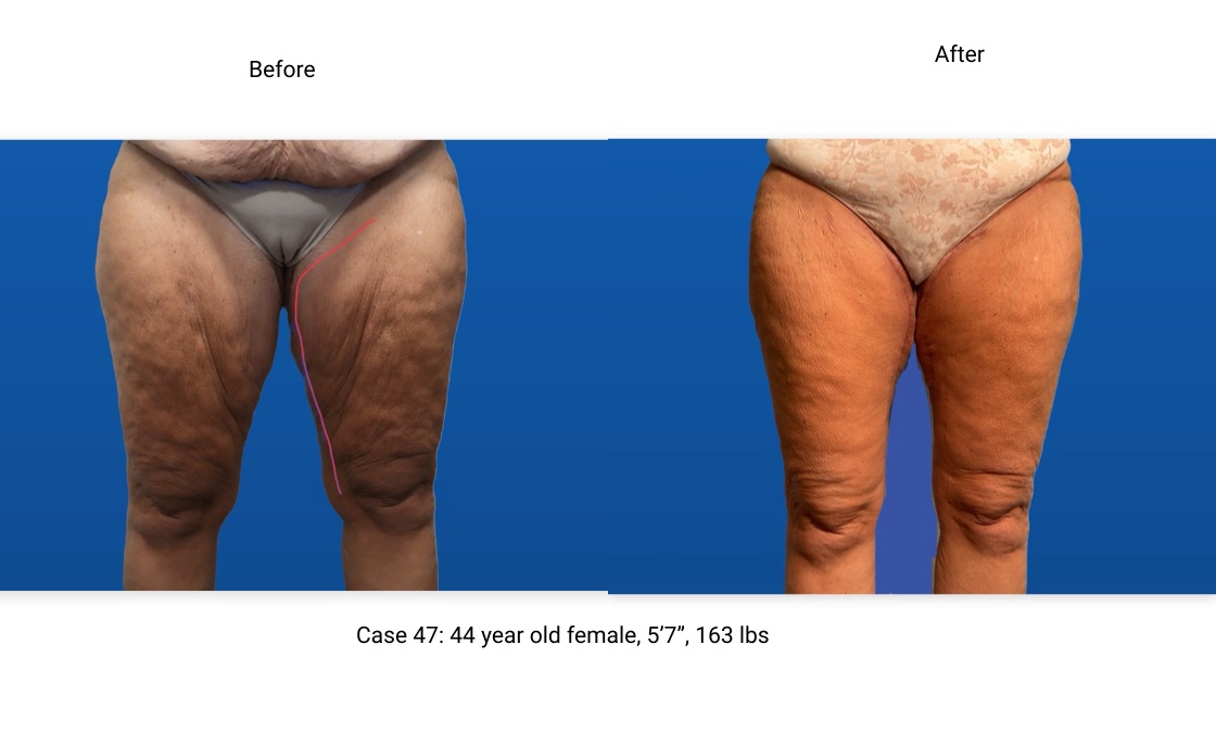Case 47 Thigh Lift Front View