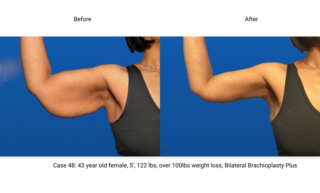 Case 48 Brachioplasty Right Arm Front View
