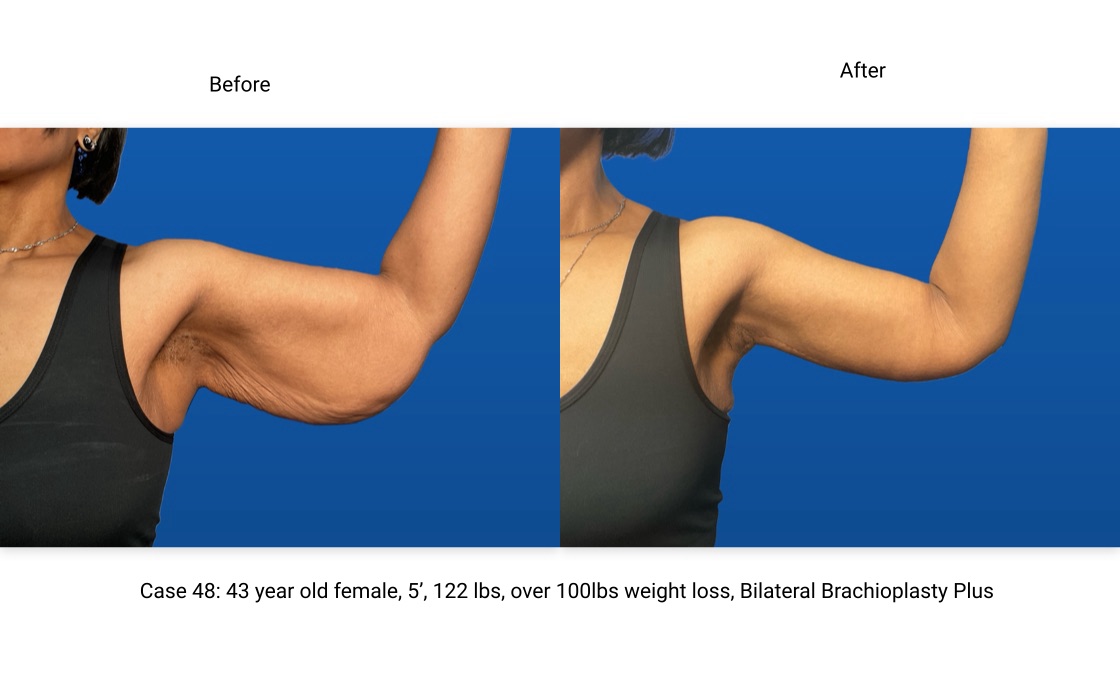 Case 48 Brachioplasty Left Arm Front View