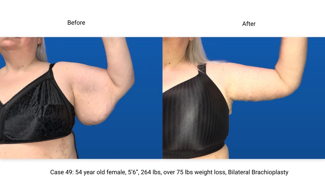 Case 49 Brachioplasty Left Arm Front View