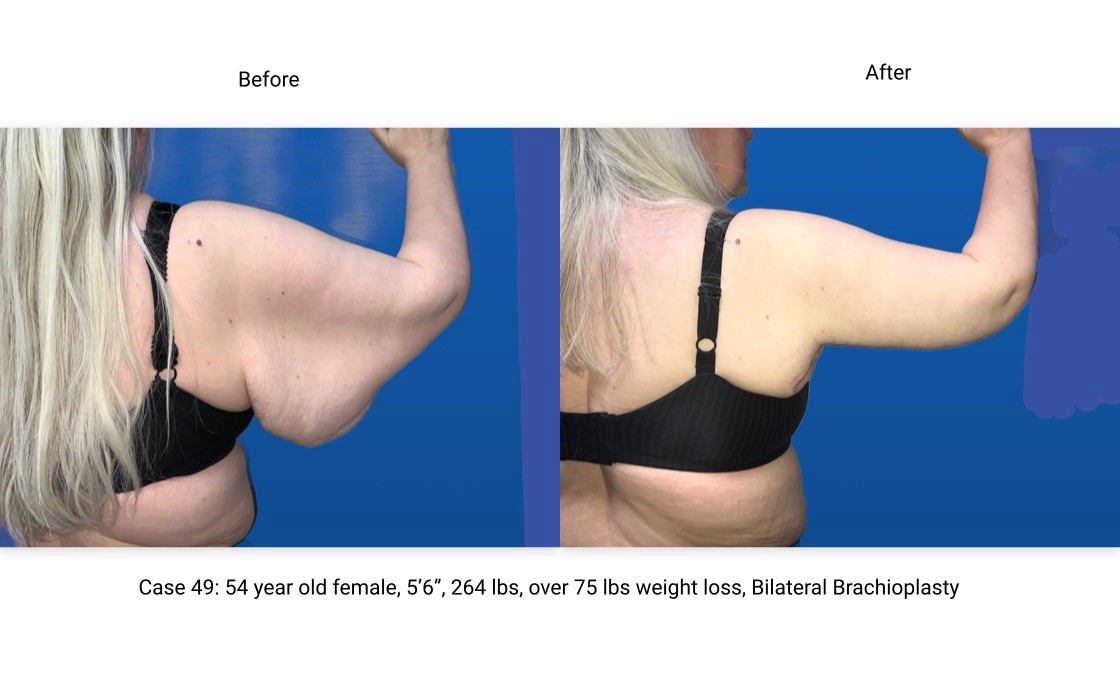Case 49 Brachioplasty Right Arm Rear View
