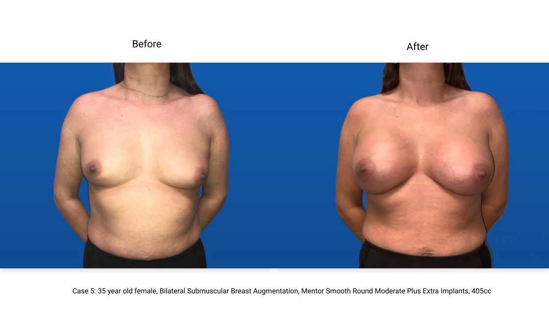 Case 5 Breast Augmentation Front View