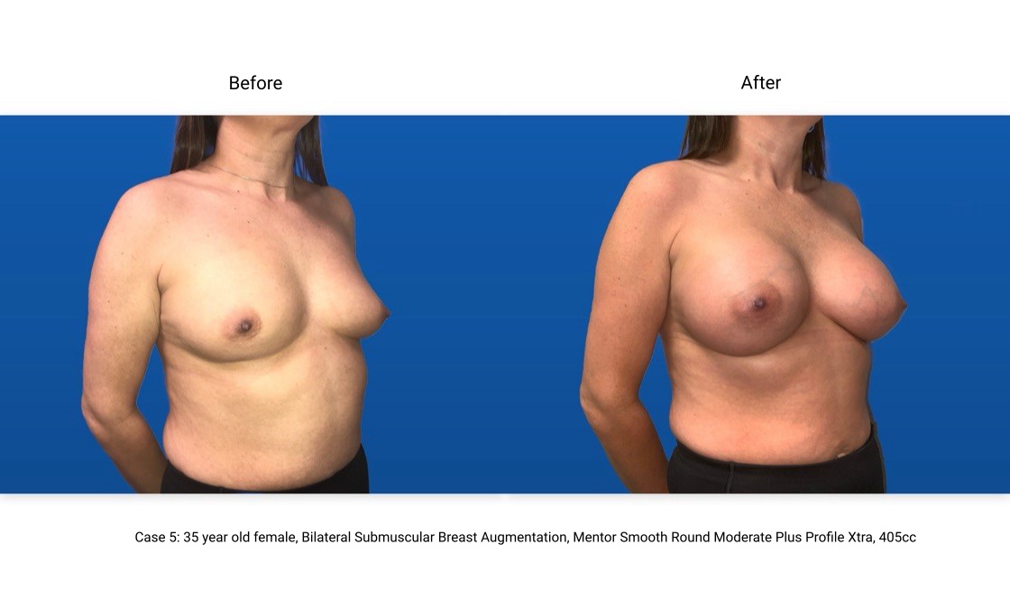 Case 5 Breast Augmentation 3/4 View