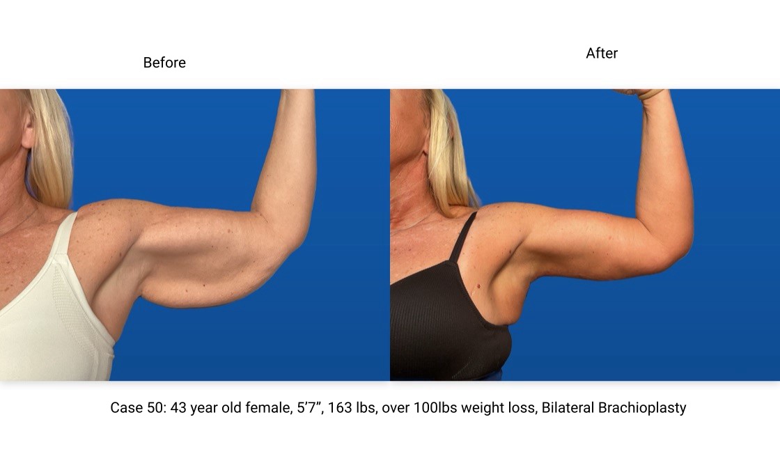 Case 50 Brachioplasty Left Arm Front View