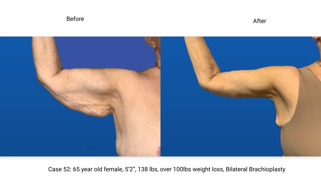 Case 51 Brachioplasty Right Arm Front View