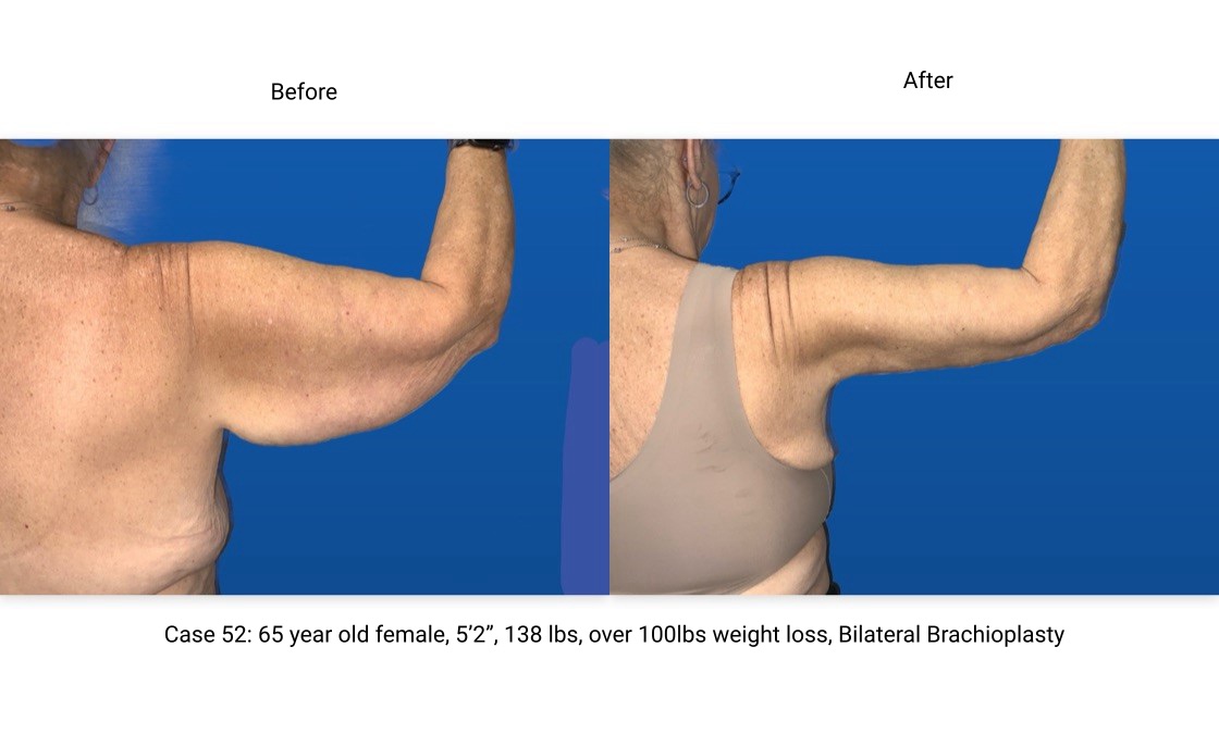 Case 51 Brachioplasty Right Arm Rear View