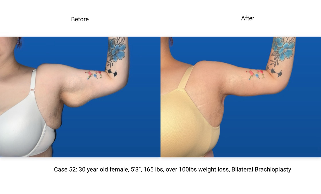 Case 52 Brachioplasty Left Arm Front View