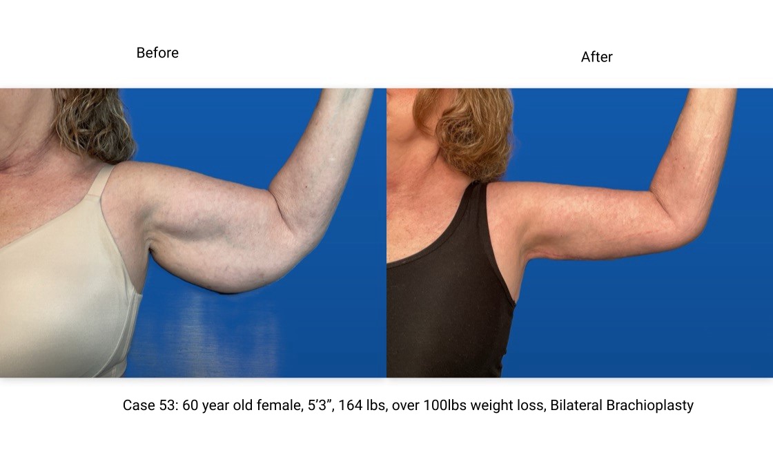 Case 53 Brachioplasty Left Arm Front View