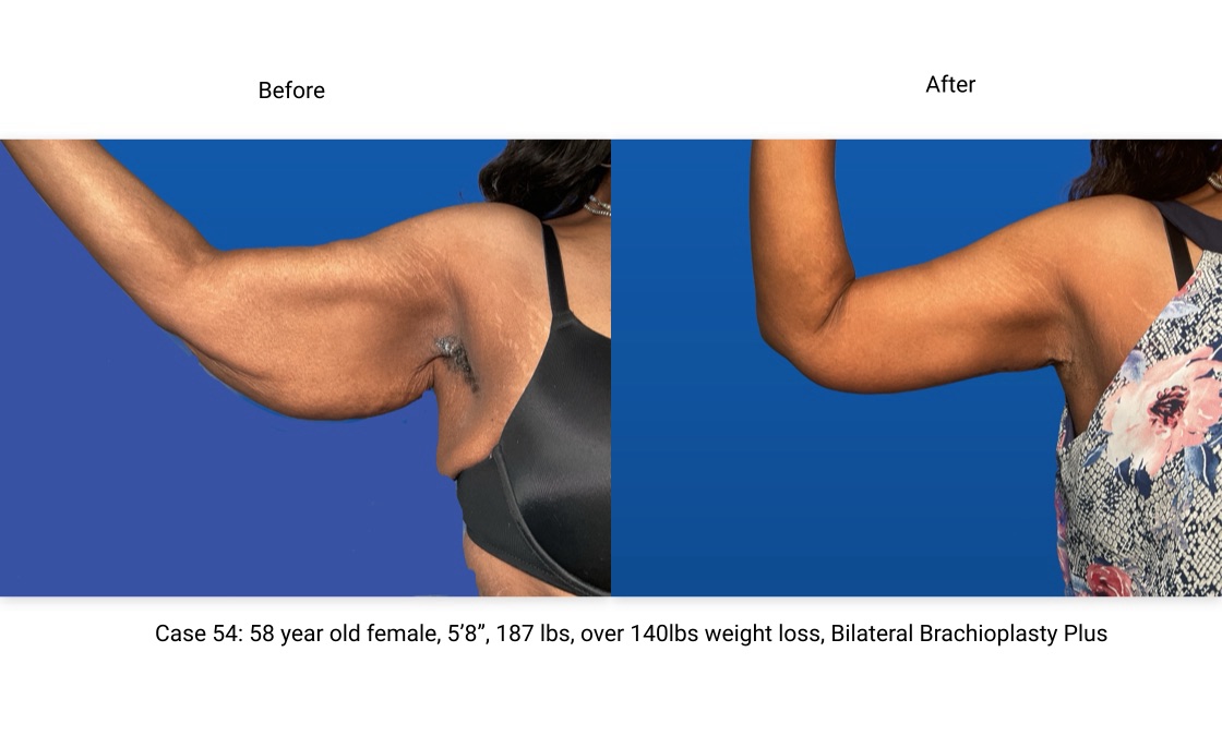 Case 54 Brachioplasty Right Arm Front View