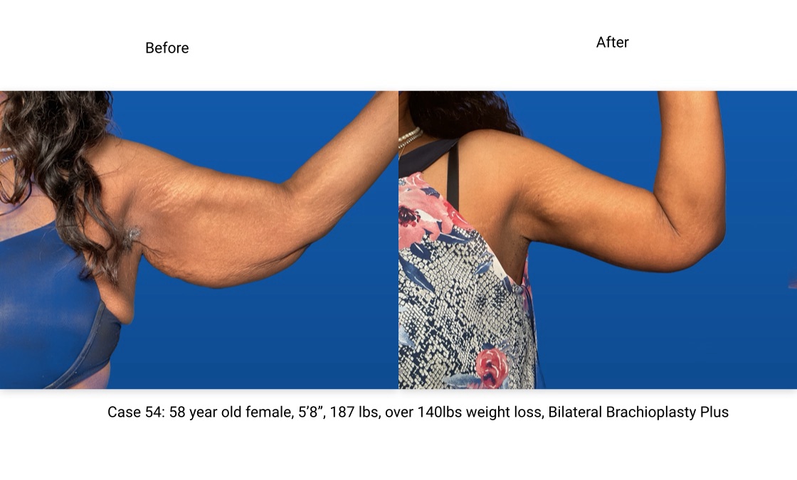 Case 54 Brachioplasty Left Arm Front View