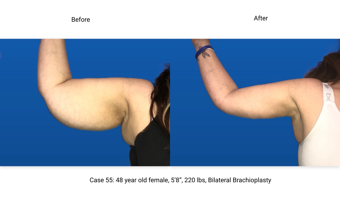 Case 55 Brachioplasty Right Arm Front View