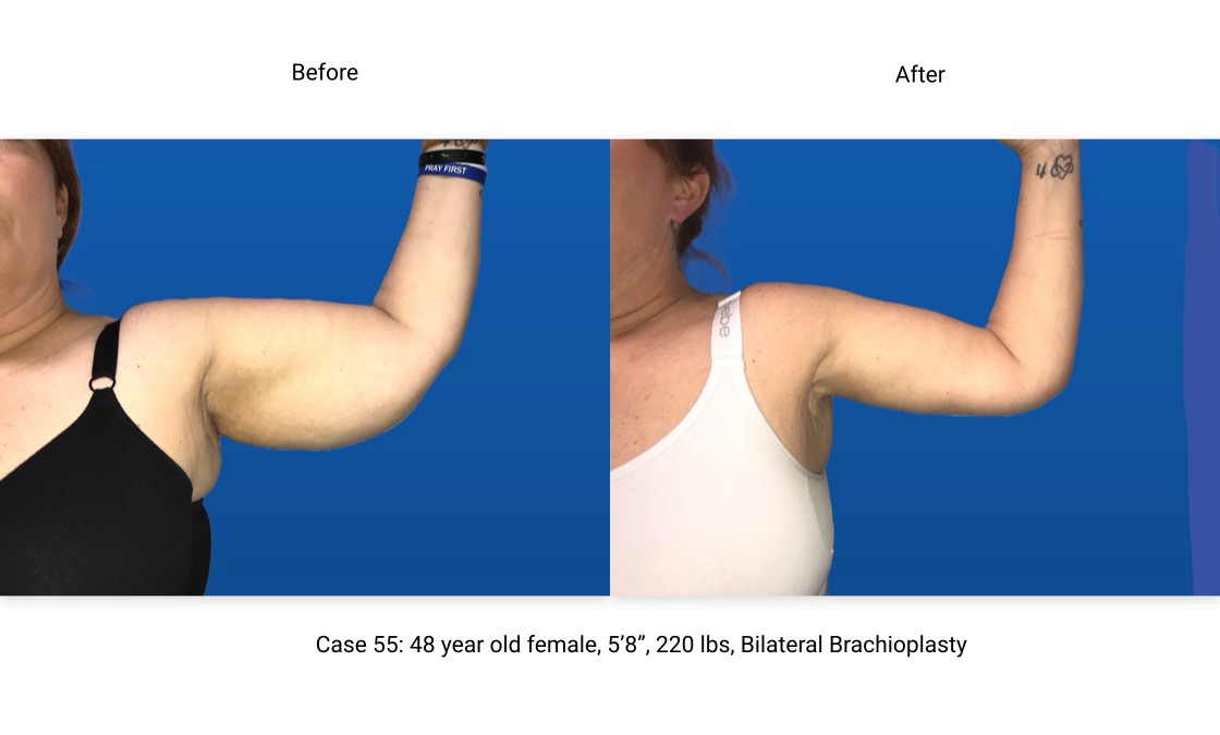 Case 55 Brachioplasty Left Arm Front View