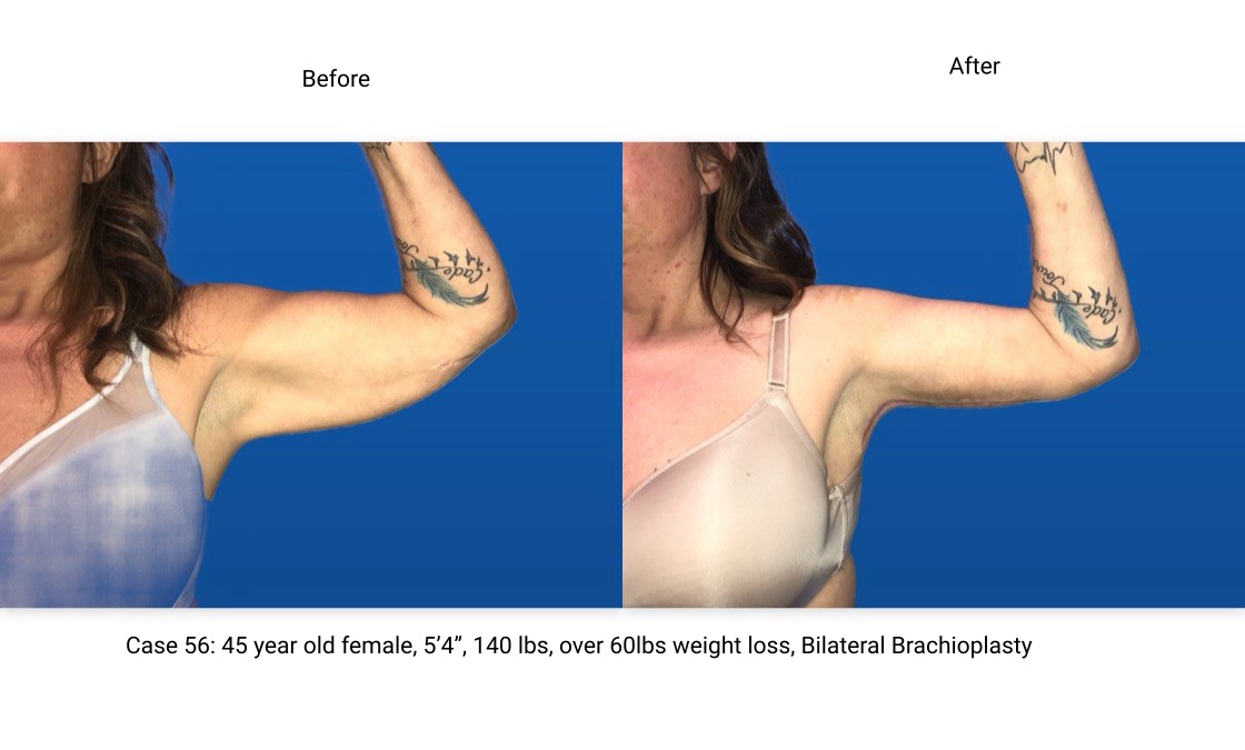 Case 56 Brachioplasty Left Arm Front View