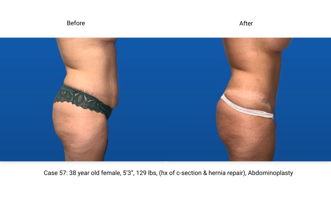 Case 57 Abdominoplasty Side View