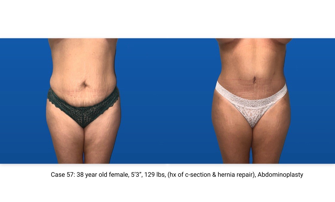 Case 57 Abdominoplasty Frontal View
