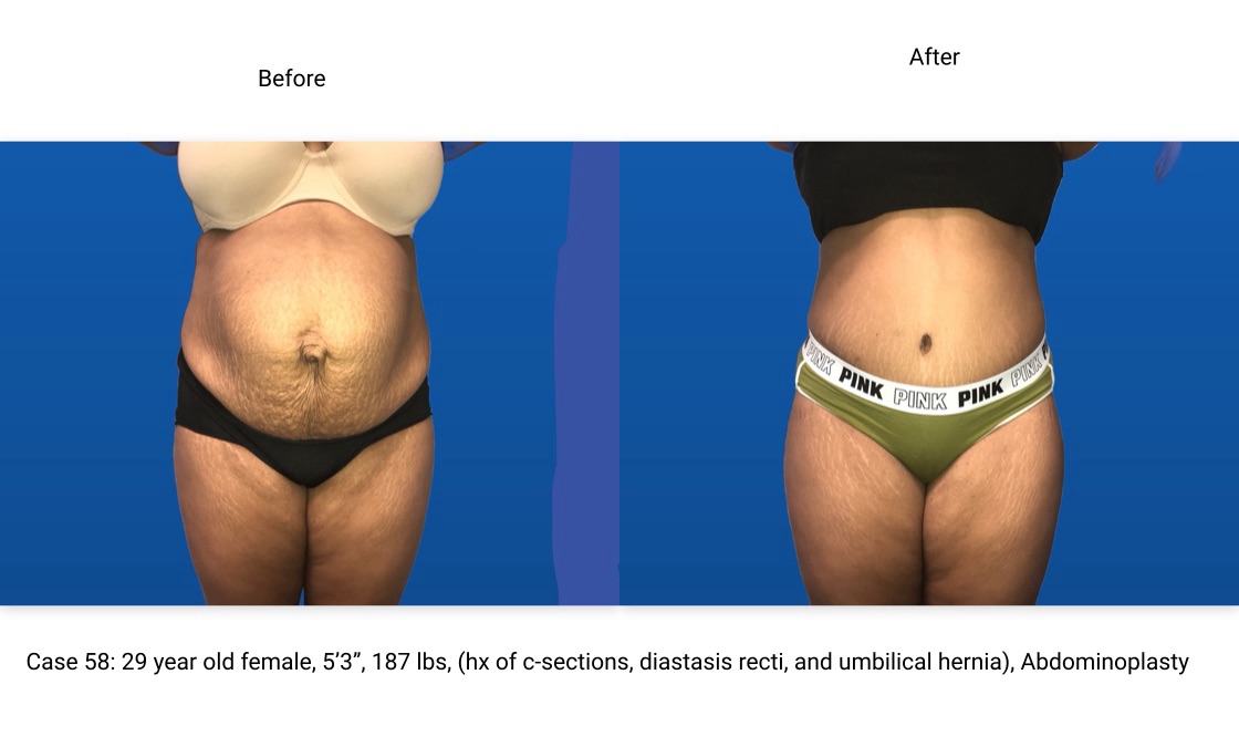 Case 58 Abdominoplasty Before and After Front View