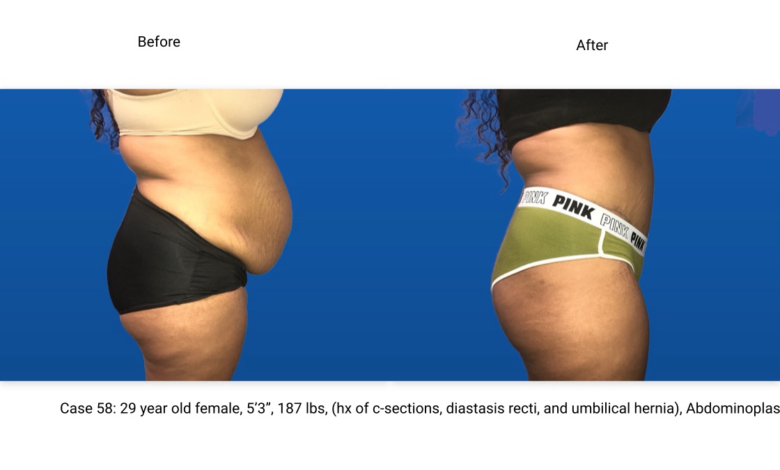 Case 58 Abdominoplasty Before and After Side View