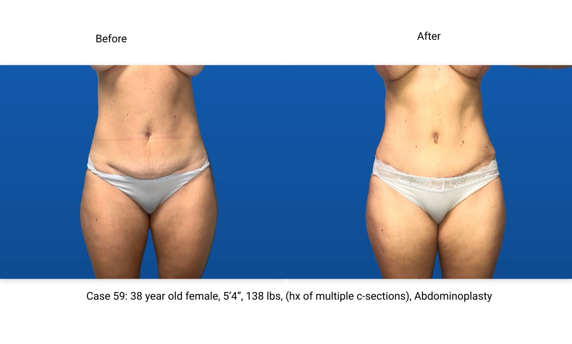 Case 59 Abdominoplasty Front View