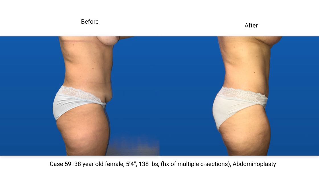 Case 59 Abdominoplasty Side View