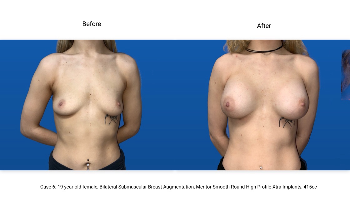 Case 6 Breast Augmentation Front View