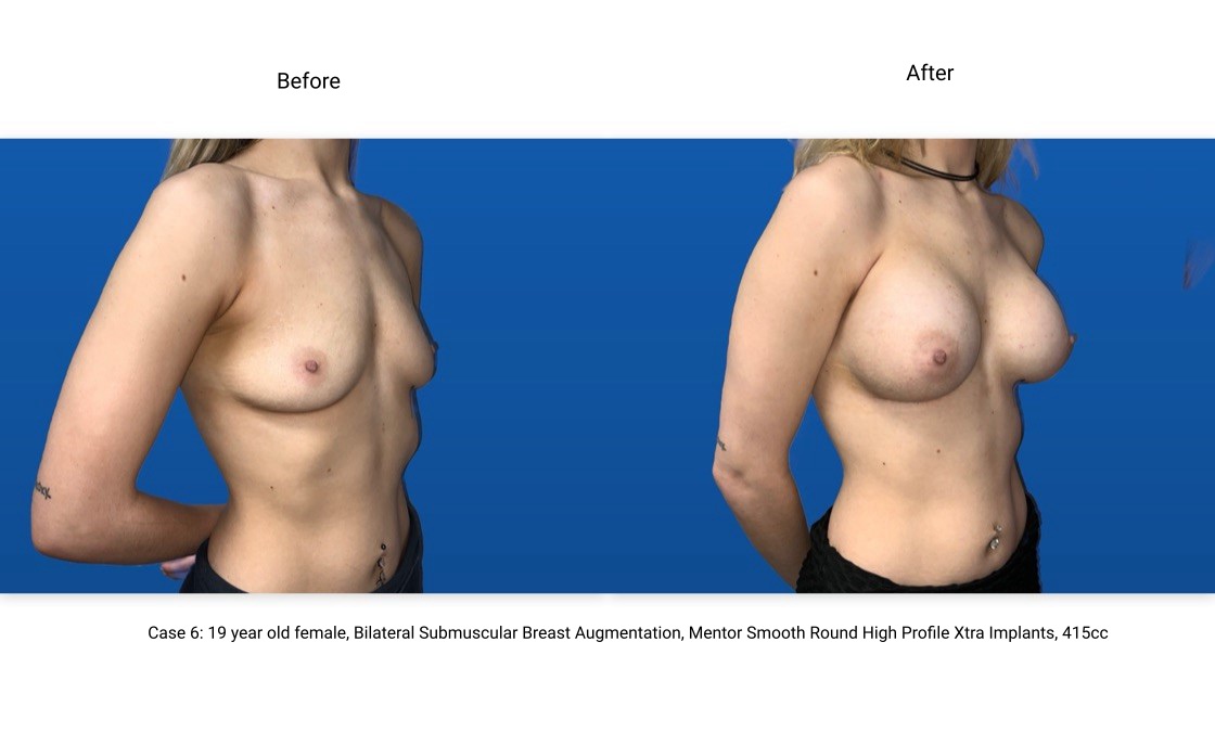 Case 6 Breast Augmentation 3/4 View
