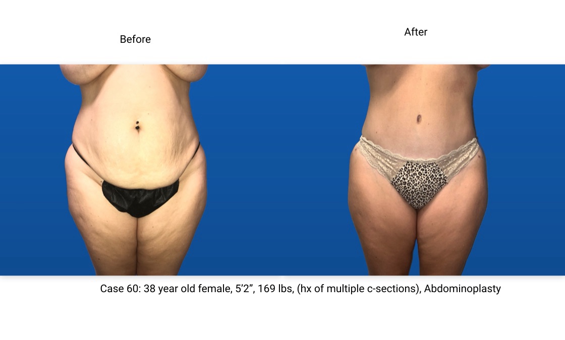 Case 60 Abdominoplasty Front View