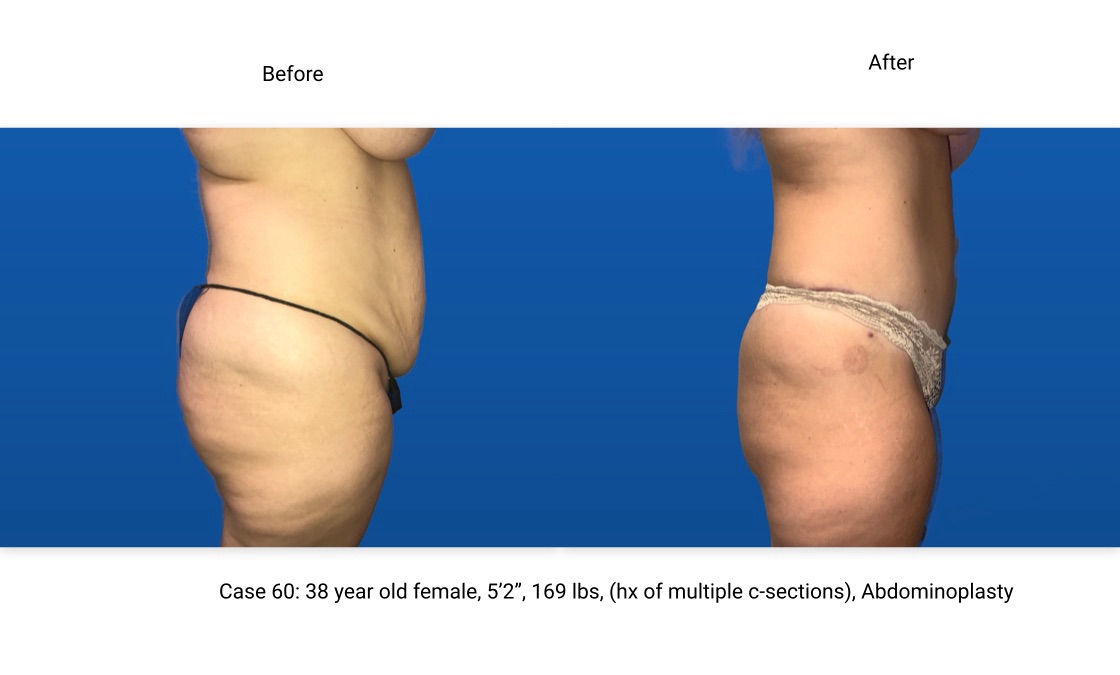 Case 60 Abdominoplasty Side View