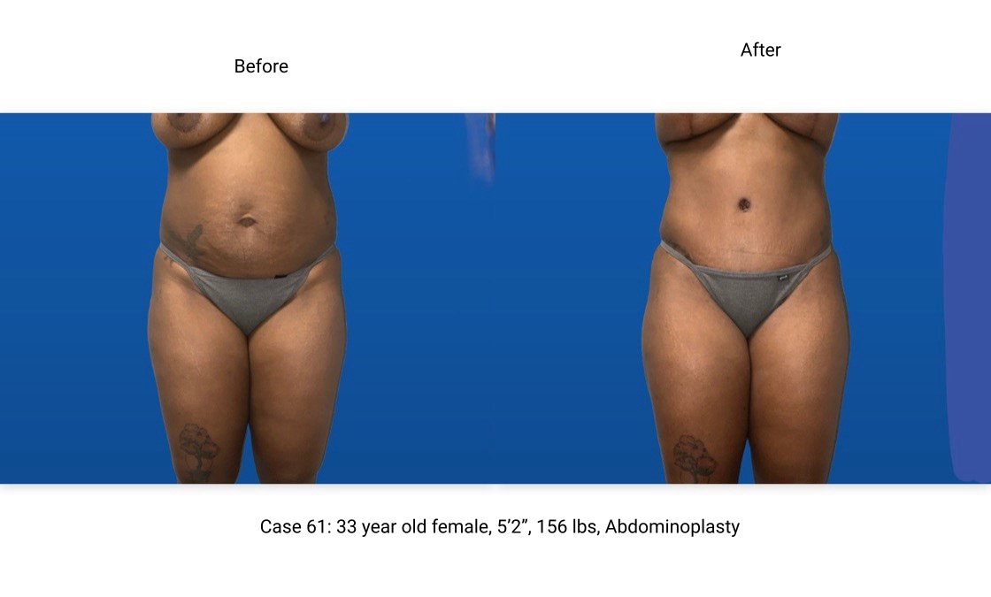 Case 61 Abdominoplasty Front View