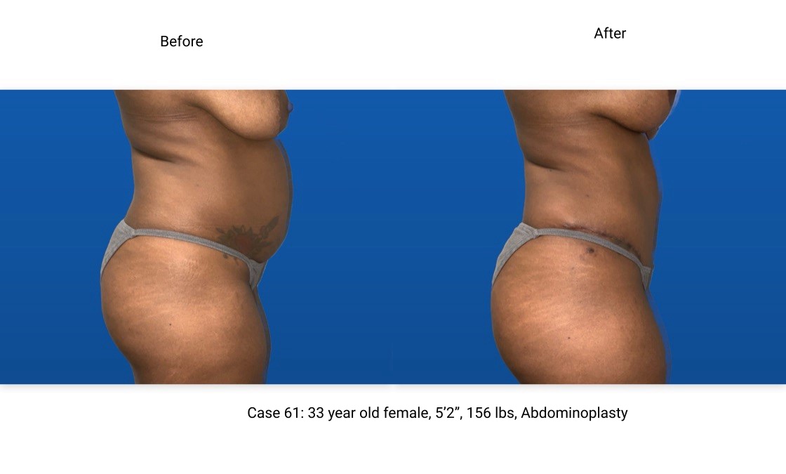 Case 61 Abdominoplasty Side View